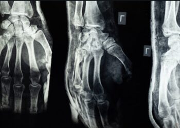 Slip and Fall Cases with Surveillance Footage: Understanding Negligience