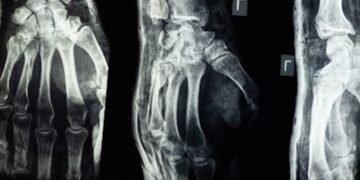 Slip and Fall Cases with Surveillance Footage: Understanding Negligience