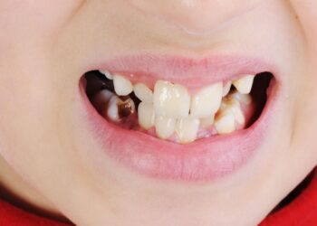 16 Things to Know About Cavities