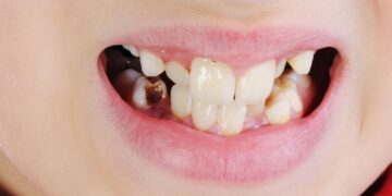 16 Things to Know About Cavities