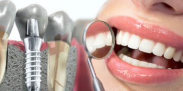 How Do Dental Implants in Midtown Compare to Other NYC Options?