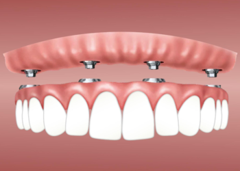 Top 4 Smile Transformation Procedures That Will Change Your Life