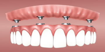 Top 4 Smile Transformation Procedures That Will Change Your Life