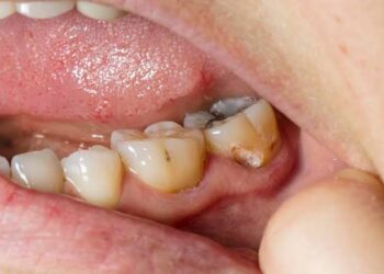 Preventing Cavities Naturally: Best Practices for Dental Care