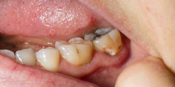 Preventing Cavities Naturally: Best Practices for Dental Care