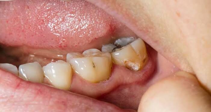 Preventing Cavities Naturally: Best Practices for Dental Care