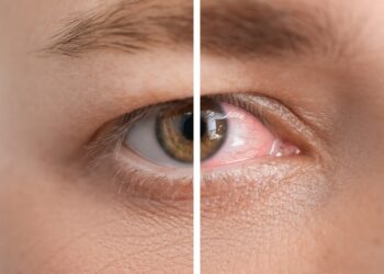 What Are the Differences Between ICL and IOL Surgeries?