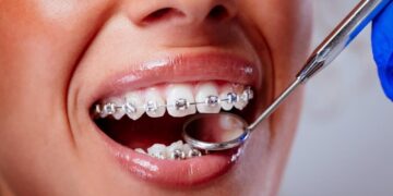 Dental Filling Procedure