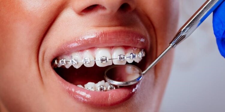 Dental Filling Procedure