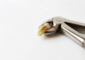 The Ultimate Guide to Tooth Extraction: What You Should Know Beforehand