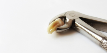 The Ultimate Guide to Tooth Extraction: What You Should Know Beforehand