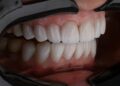 The Ultimate Guide to Gums Treatment: Everything You Need to Know