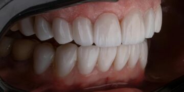 The Ultimate Guide to Gums Treatment: Everything You Need to Know