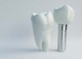 How Dental Implants Improve Your Smile And Confidence