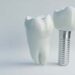 How Dental Implants Improve Your Smile And Confidence