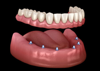 The Benefits of Overdentures: Why You Should Consider Them