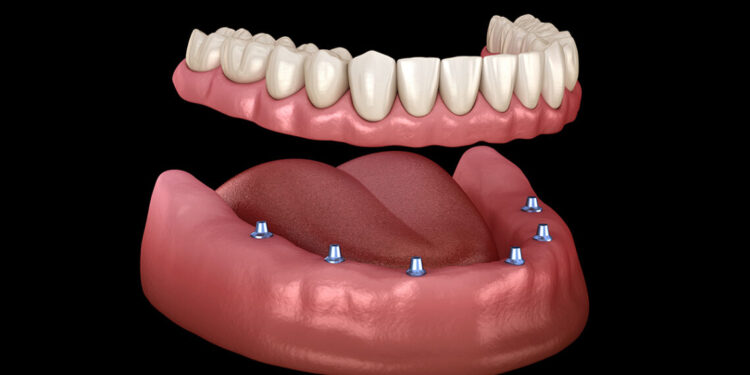 The Benefits of Overdentures: Why You Should Consider Them