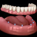 The Benefits of Overdentures: Why You Should Consider Them