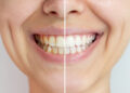 Teeth Whitening: Pros and Cons