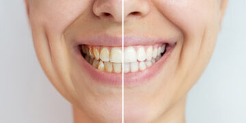 Teeth Whitening: Pros and Cons
