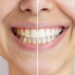 Teeth Whitening: Pros and Cons