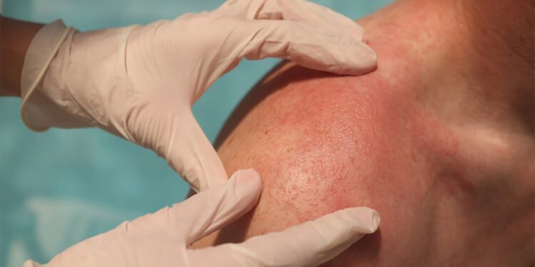 Does Anti Itch Cream Actually Numb Your Skin’s Surface?