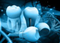 Smile Again with All-on-4: The Future of Dental Implant Solutions