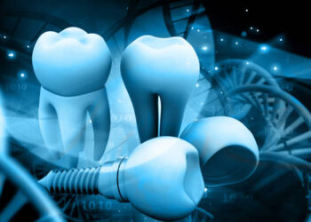 Smile Again with All-on-4: The Future of Dental Implant Solutions