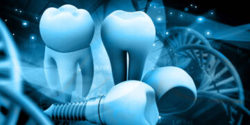 Smile Again with All-on-4: The Future of Dental Implant Solutions