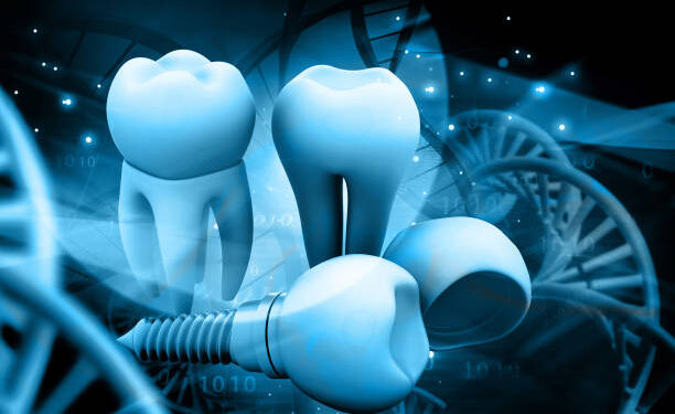 Smile Again with All-on-4: The Future of Dental Implant Solutions