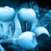 Smile Again with All-on-4: The Future of Dental Implant Solutions