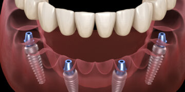 Dentures