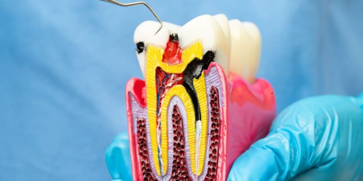 Root Canals