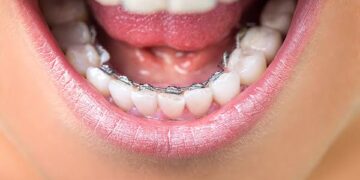 The Benefits of Teeth Straightening for Adults