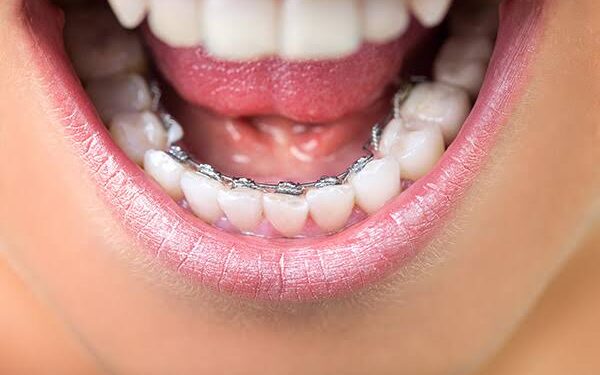 The Benefits of Teeth Straightening for Adults