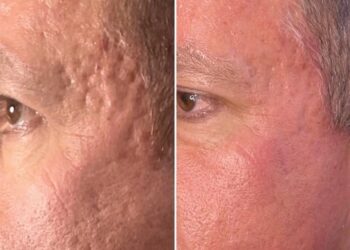 Discover the Benefits of Skin Rejuvenation in Perth