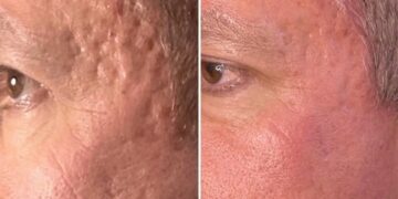 Discover the Benefits of Skin Rejuvenation in Perth