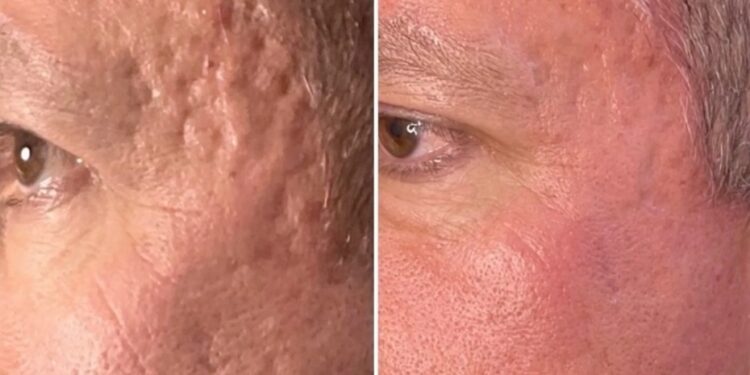 Discover the Benefits of Skin Rejuvenation in Perth