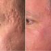 Discover the Benefits of Skin Rejuvenation in Perth